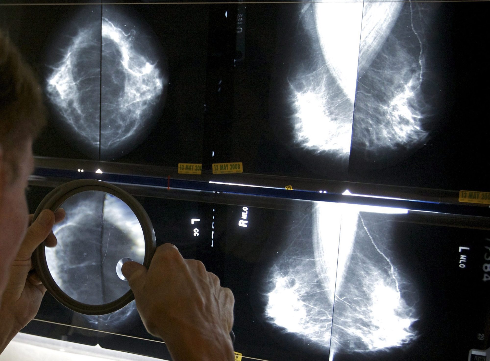 Breast cancer: Free screening has now been expanded to include Quebec women aged 70 to 74 years
